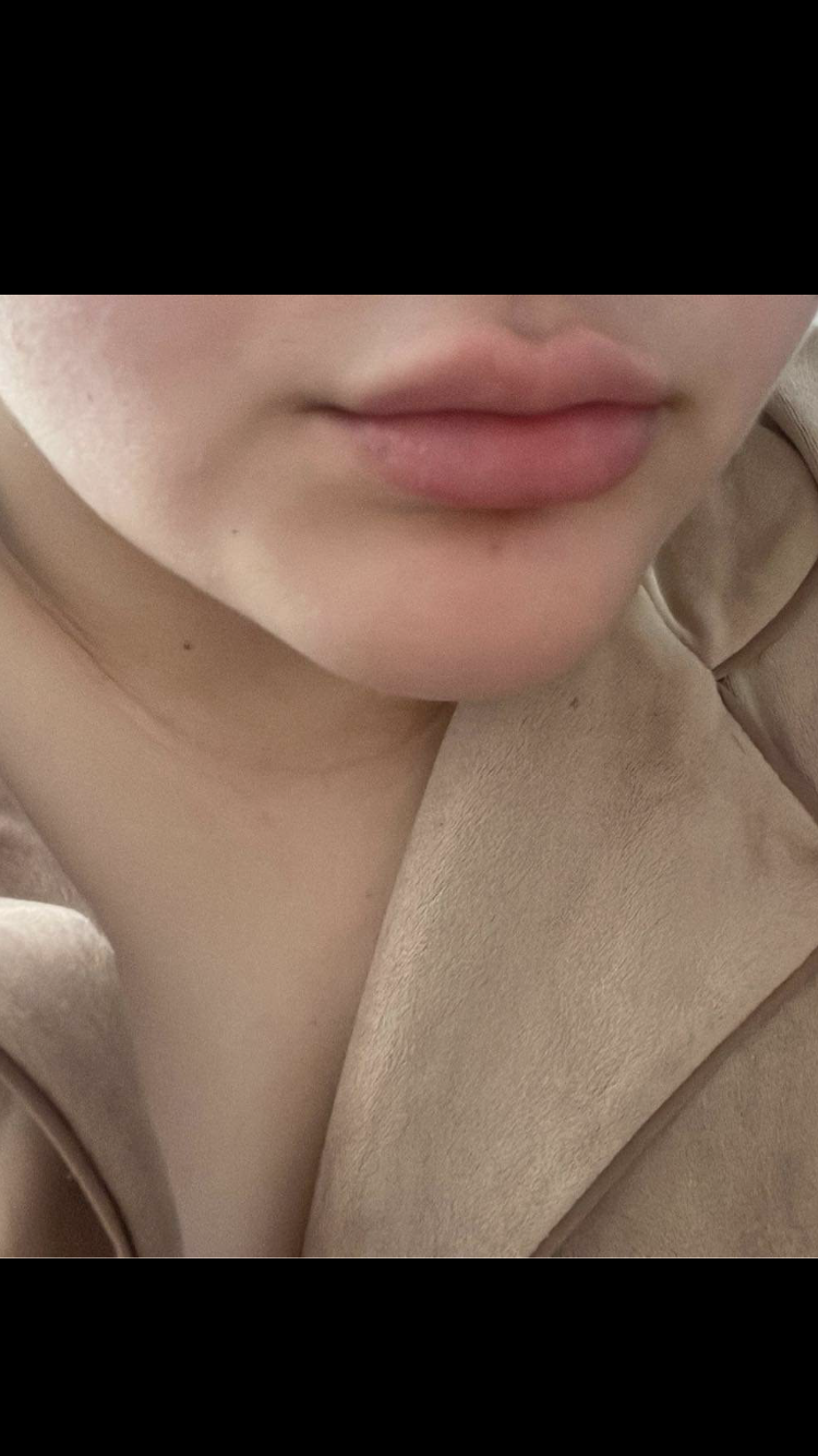 Lumifill 1 ml dermal filler