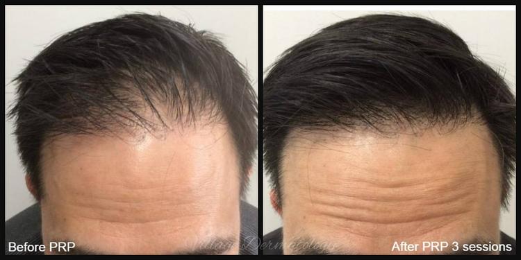 PRP hair restoration